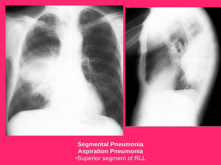 chest xrays pneumonias