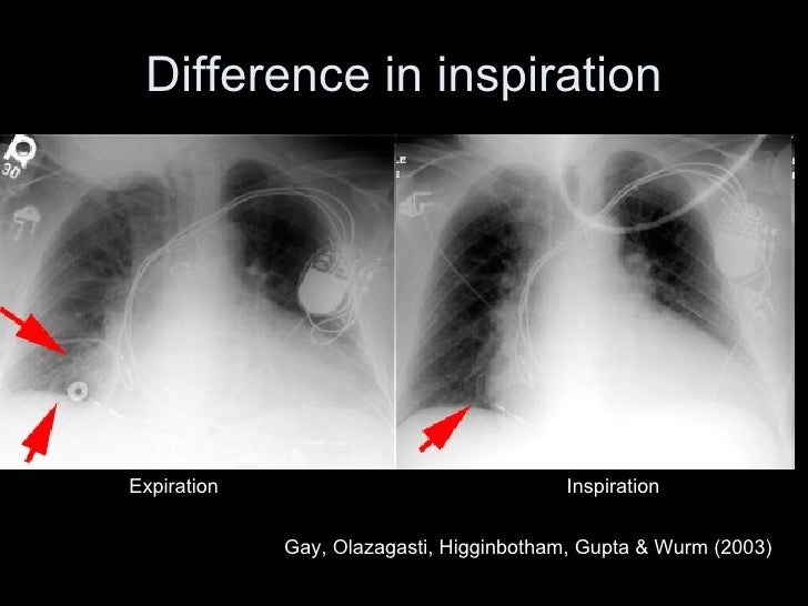 Chest Radiographs