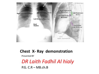 Chest X- Ray demonstration
Presented BY

DR Laith Fadhil Al hialy
P.G. C.R – MB.ch.B

 