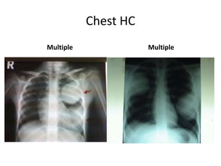 Chest HC
Multiple

Multiple

 