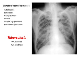 Bilateral Upper Lobe Disease
Tuberculosis
Sarcoidosis
Histoplasmosis
Silicosis
Ankylosing spondylitis
Eosinophilic granuloma

Tuberculosis
LUL cavities
RUL infiltrate

 