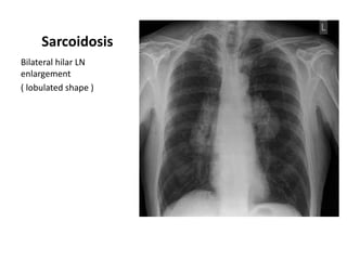 Sarcoidosis
Bilateral hilar LN
enlargement
( lobulated shape )

 