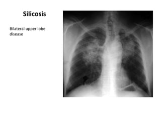 Silicosis
Bilateral upper lobe
disease

 