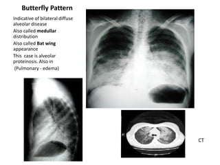 Butterfly Pattern
Indicative of bilateral diffuse
alveolar disease
Also called medullar
distribution
Also called Bat wing
appearance
This case is alveolar
proteinosis. Also in
(Pulmonary - edema)

CT

 