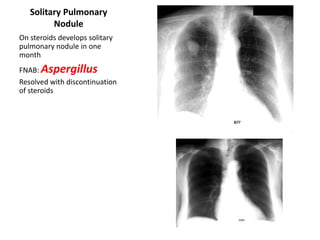 Solitary Pulmonary
Nodule
On steroids develops solitary
pulmonary nodule in one
month
FNAB: Aspergillus
Resolved with discontinuation
of steroids

 
