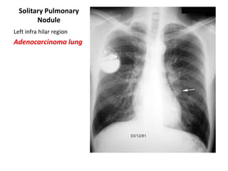 Solitary Pulmonary
Nodule
Left infra hilar region

Adenocarcinoma lung

 