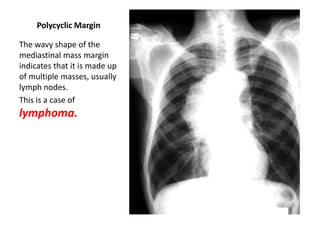 Polycyclic Margin
The wavy shape of the
mediastinal mass margin
indicates that it is made up
of multiple masses, usually
lymph nodes.
This is a case of

lymphoma.

 