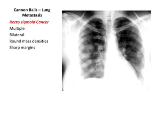 Cannon Balls – Lung
Metastasis
Recto sigmoid Cancer
Multiple
Bilateral
Round mass densities
Sharp margins

 