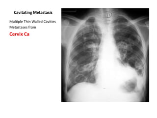 Cavitating Metastasis
Multiple Thin Walled Cavities
Metastases from

Cervix Ca

 