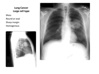 Lung Cancer
Large cell type
Mass
Round or oval
Sharp margin
Homogenous

 
