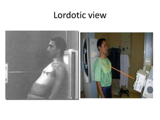 Lordotic view

 