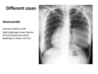 Different cases
Dextrocardia
Stomach bubble on left
Right diaphragm lower Position
of heart determines which
diaphragm is lower, not liver.

 