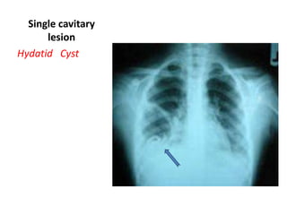 Single cavitary
lesion
Hydatid Cyst

 