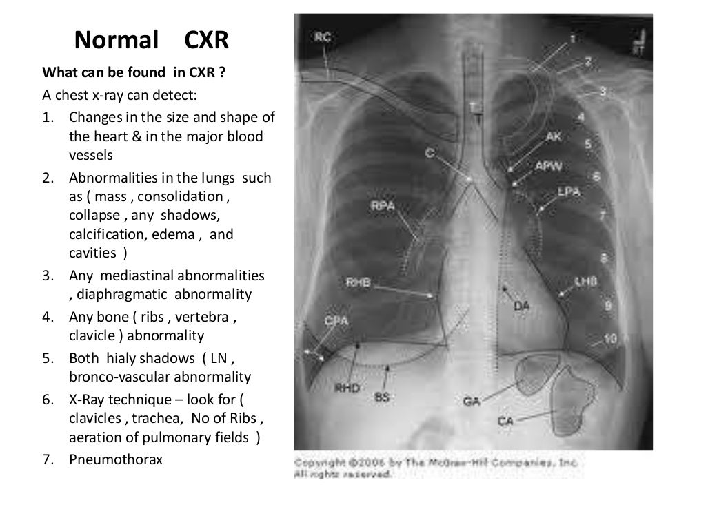 Chest x ray