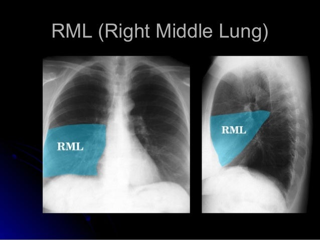 CXR Simple by DrRaghu Ram