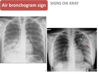 chest-x-ray-teaching-tutorial.pptx