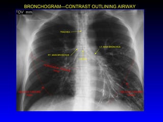 CARINA LT. MAIN BRONCHUS RT. MAIN BRONCHUS TRACHEA OBLIQUE FISSURE (major) OBLIQUE FISSURE major HORIZONTAL FISSURE minor BRONCHOGRAM—CONTRAST OUTLINING AIRWAY 