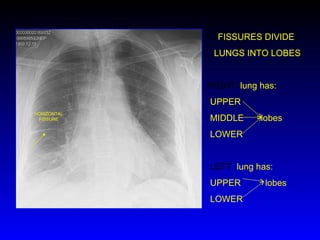 HORIZONTAL FISSURE FISSURES DIVIDE  LUNGS INTO LOBES RIGHT  lung has: UPPER  MIDDLE  lobes LOWER LEFT  lung has: UPPER  lobes LOWER 