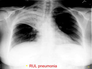 RUL pneumonia 