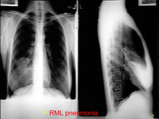 RML pneumonia 