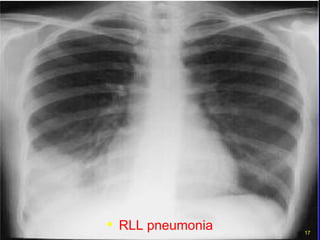 RLL pneumonia 