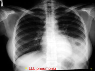 LLL pneumonia 