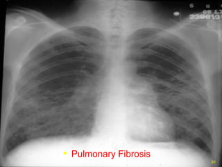 Pulmonary Fibrosis 