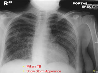 Miliary TB Snow Storm Apperance 