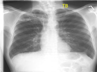 TB 