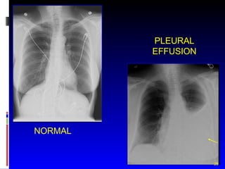PLEURAL EFFUSION NORMAL 