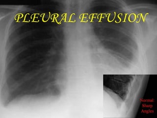 PLEURAL EFFUSION 