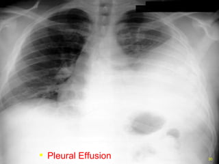 Pleural Effusion 
