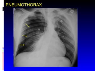 PNEUMOTHORAX 
