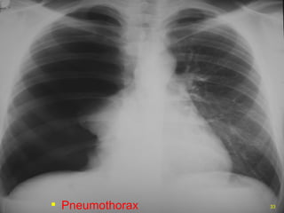 Pneumothorax 