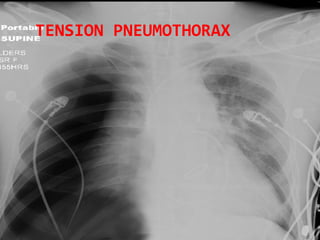 TENSION PNEUMOTHORAX 