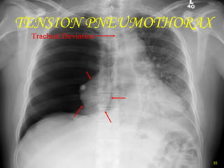 TENSION PNEUMOTHORAX 