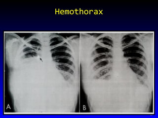 Hemothorax 