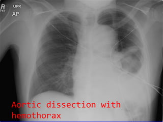 Aortic dissection with hemothorax 