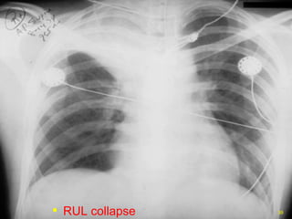 RUL collapse 