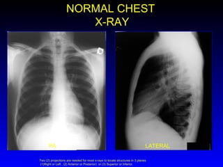 NORMAL CHEST X-RAY PA LATERAL Two (2) projections are needed for most x-rays to locate structures in 3 planes  (1)Right or Left , (2) Anterior or Posterior)  or (3) Superior or Inferior.  