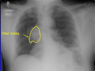 Chest mass, emphysema Hilar mass 