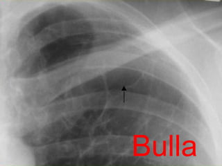 Bulla 