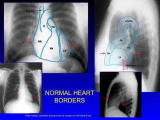 NORMAL HEART BORDERS Note cardiac chambers that account for margins on the chest X-ray 