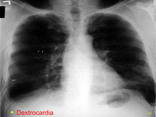 Dextrocardia 