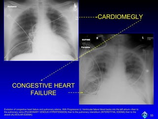 CARDIOMEGLY CONGESTIVE   HEART FAILURE Evolution of congestive heart failure and pulmonary edema. With Progressive Lt. Ventricular failure blood backs into the left atrium—then to the pulmonary veins (PULMONARY VENOUS HYPERTENSION) then to the pulmonary interstitium (INTERSTITIAL EDEMA) then to the alveoli (ALVEOLAR EDEMA) 