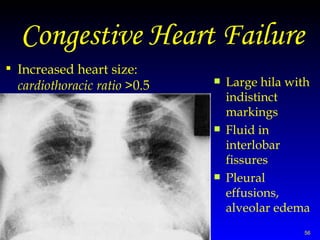 Congestive Heart Failure Increased heart size:  cardiothoracic ratio  >0.5 Large hila with indistinct markings Fluid in interlobar fissures Pleural effusions, alveolar edema 