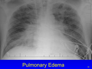 Pulmonary Edema 