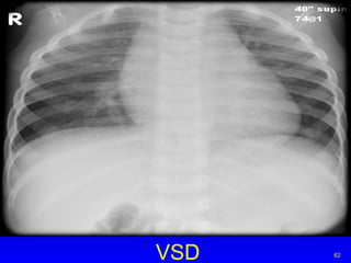 VSD 
