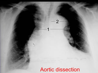 Aortic dissection 