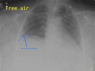 Free air Free air beneath diaphragm 